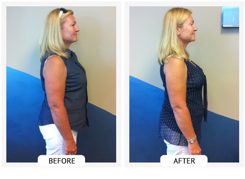 Chiropractic Wilmington DE Before and After Results jeanie Chiropractic Wilmington DE Before and After Results jeanie