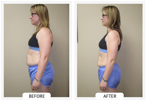 Chiropractic Wilmington DE Before and After Results kristen Chiropractic Wilmington DE Before and After Results kristen